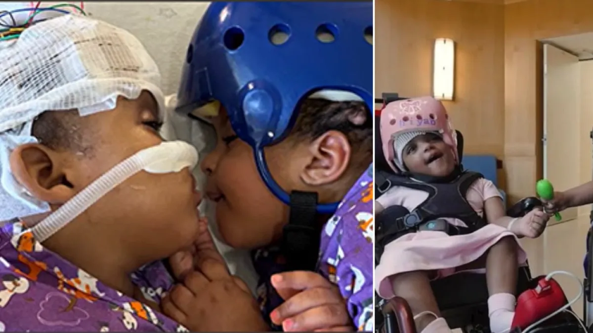 Bebés siamesas unidas por la cabeza fueron separadas tras una compleja cirugía de más de 24 horas en Estados Unidos